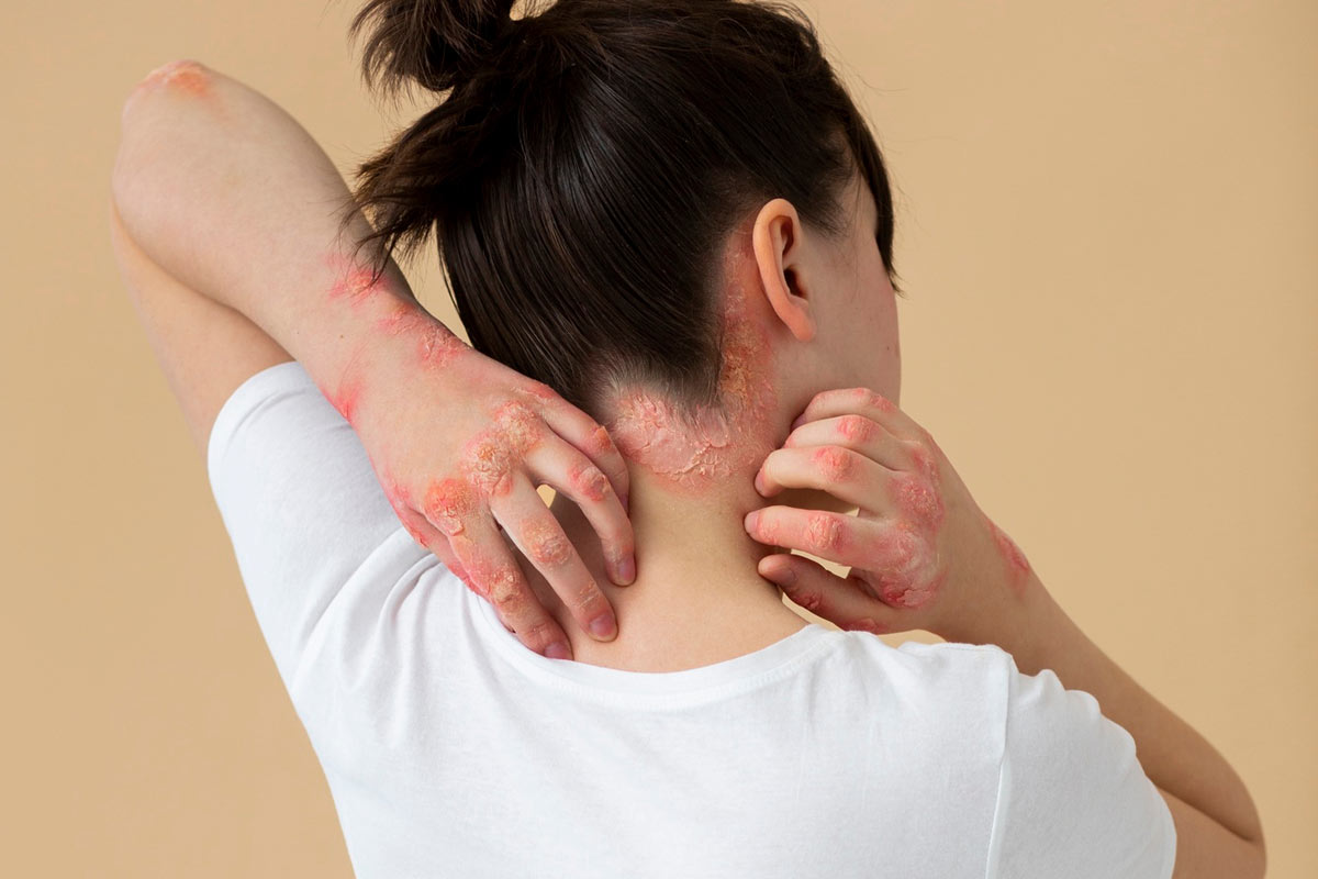 Kératose actinique : Causes, symptômes et traitement