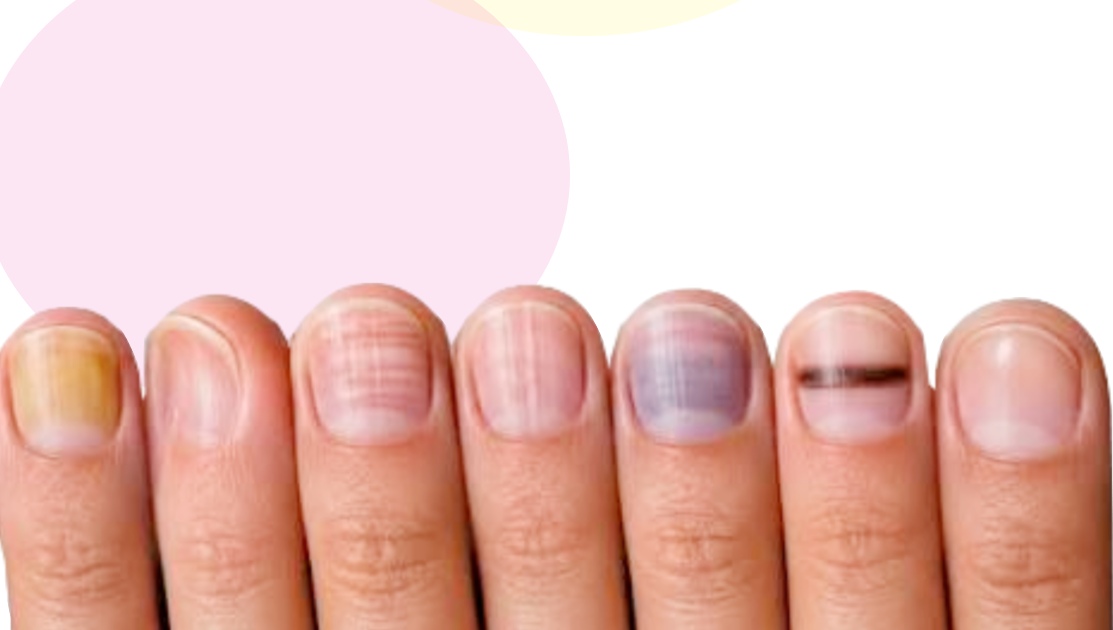 Ongles : 8 signes à surveiller