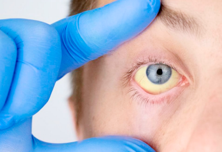 Cholestase : les signes qui doivent alerter