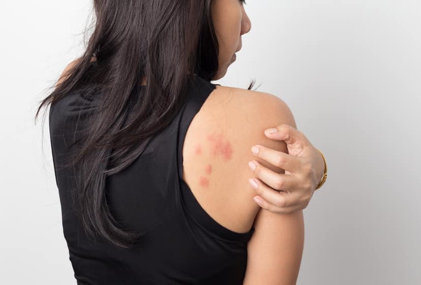 Urticaire : pourquoi ces plaques rouges apparaissent-elles sur la peau ?